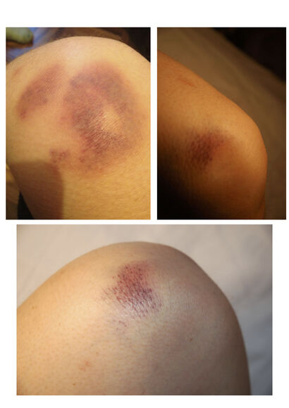 Bruised Knees - A Photographic Art Artwork by Elsa Stanyer